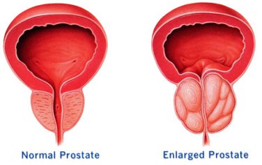 6 Main Causes Of Prostate Enlargement